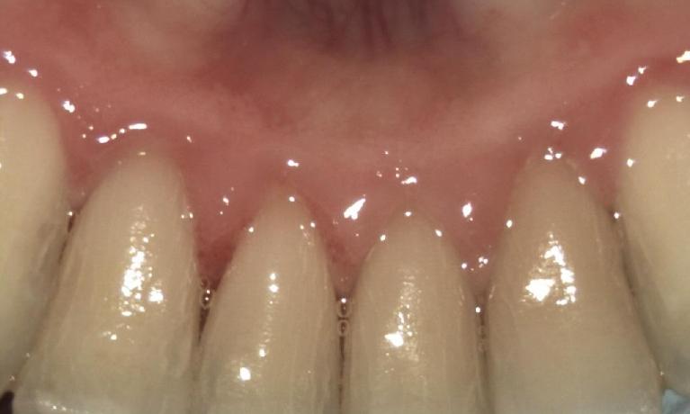 Periodontal-Treatment-After-Image