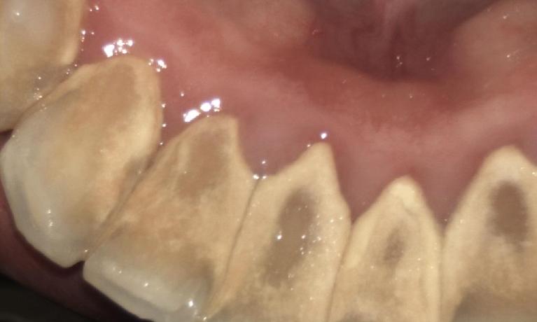 Periodontal-Treatment-Before-Image